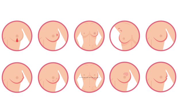 Sintomas cáncer de mama